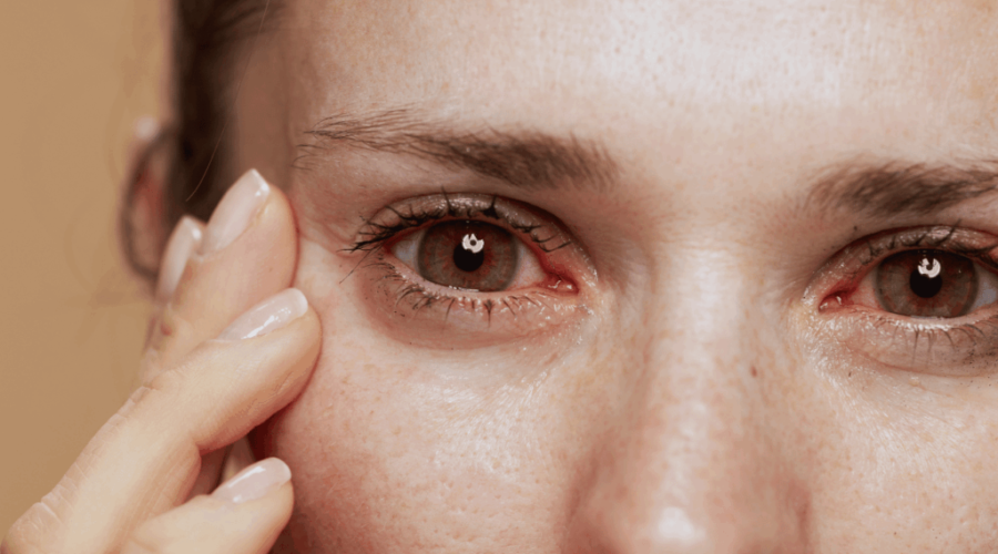 ojos irritados